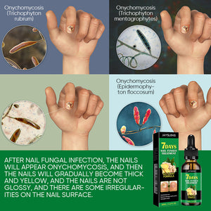 Ginger Nail Treatment